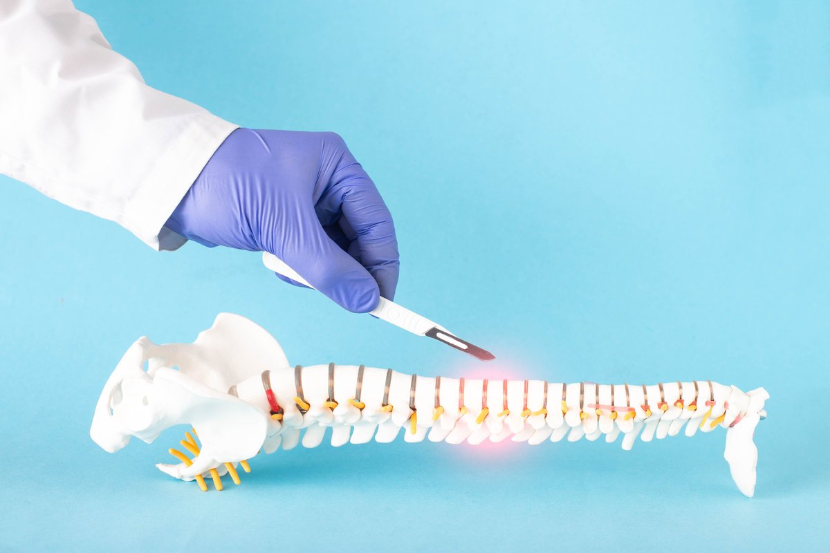 Doctor's hand with a scalpel near the mock up of the human spine on a blue background. Spine surgery concept, vertebroplasty, copy space for text, microdiscectomy